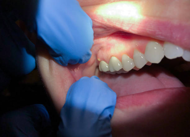 Best Emergency Gum Treatment in Rose Hill, KS